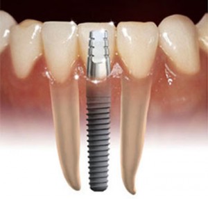 dental-implant-111-300x286