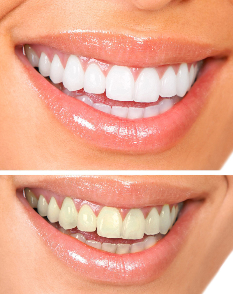 2 Excellent Reasons to Consider Getting Porcelain Veneers in Salisbury, NC