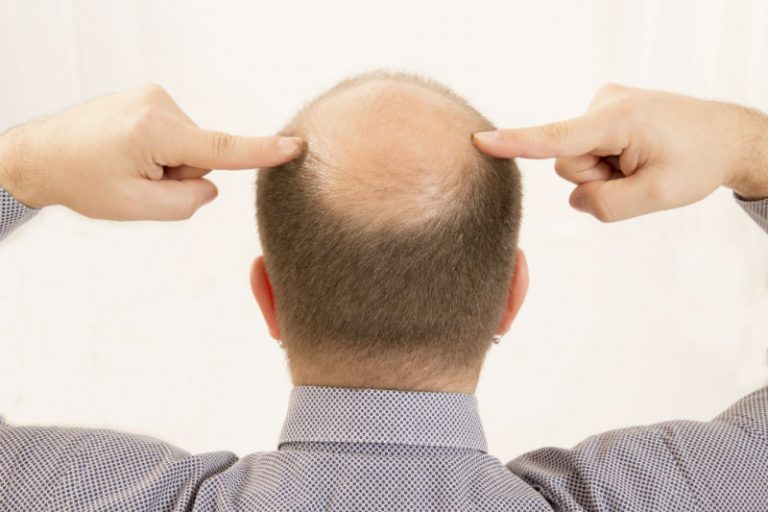 Men in NY Turn to Hair Restoration as a Permanent Solution to Balding