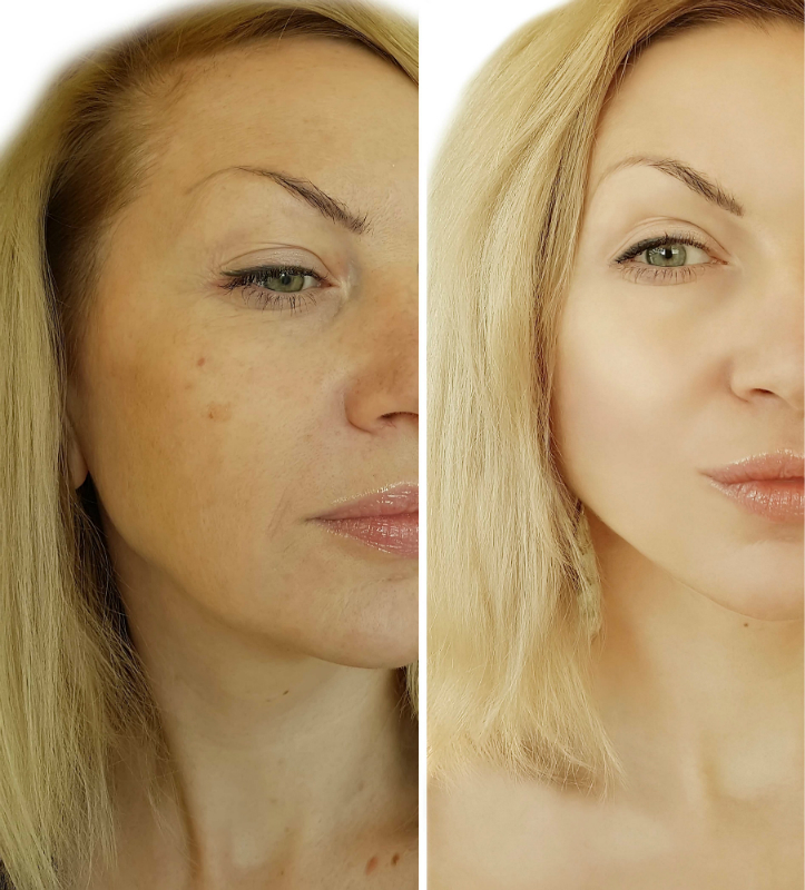 How a Neck Lift in California Can Give You a More Youthful Appearance