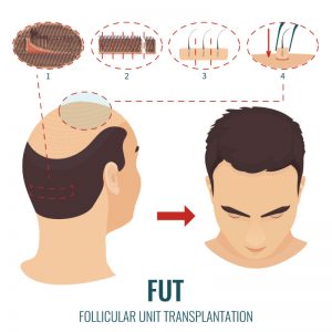Get a Hair Transplant and Get the Hair Your Want in New Jersey