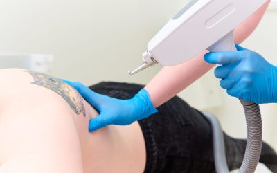 For Reliable Tattoo Removal in Minneapolis, MN, Only the Experts Will Do