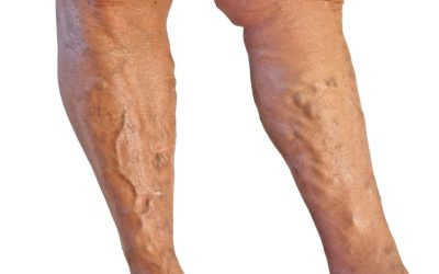 Understanding Leg Swelling: What Hoffman Estates Residents Should Know