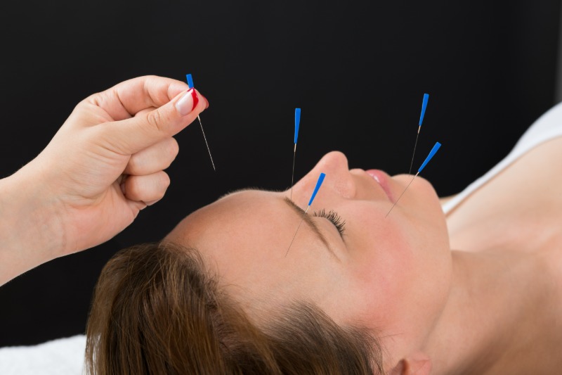 Improve Your Wellbeing Through Holistic Healing Using Acupuncture Therapy in Newark, CA